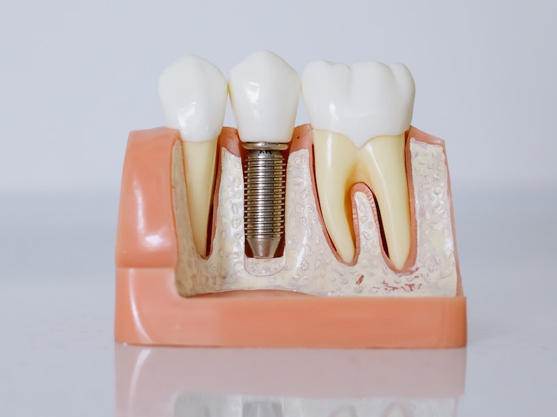 Dental Implants